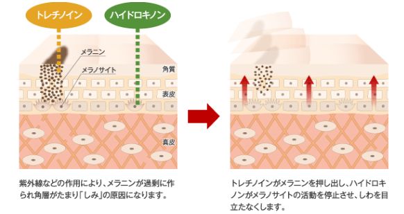 トレチノイン,ハイドロキノン,美白