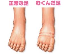 ラシックス,ジェネリック,,口コミ
